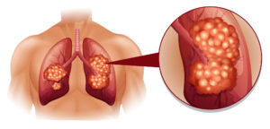 肺がん　粒子線治療　重粒子線治療