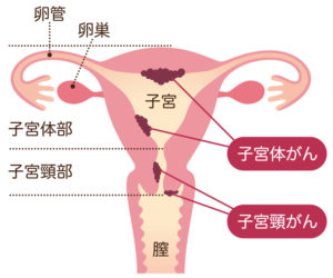 子宮頸がん　ステージ