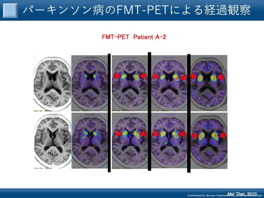 パーキンソン病のFMT-PETによる経過観察