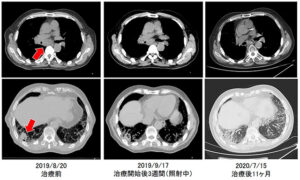 コンビネーション放射線治療症例①「肺がん・縦隔リンパ節転移がん」