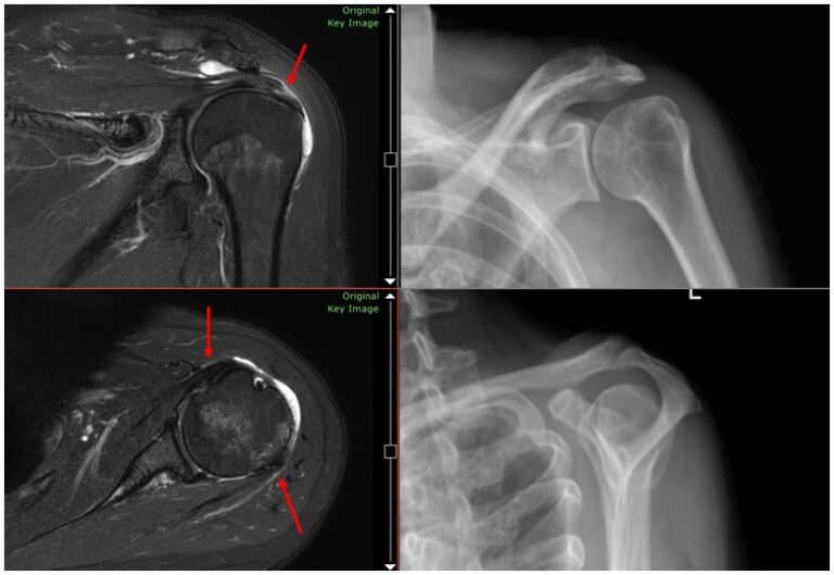 肩関節炎とともに生きる