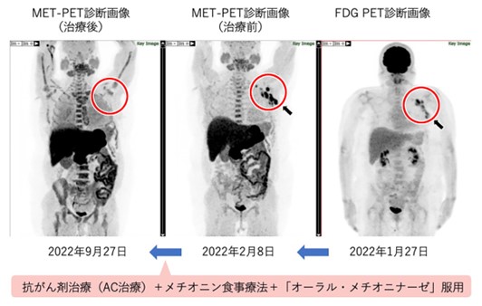 メチオニン制限治療の効果と全身のMET-PET診断画像