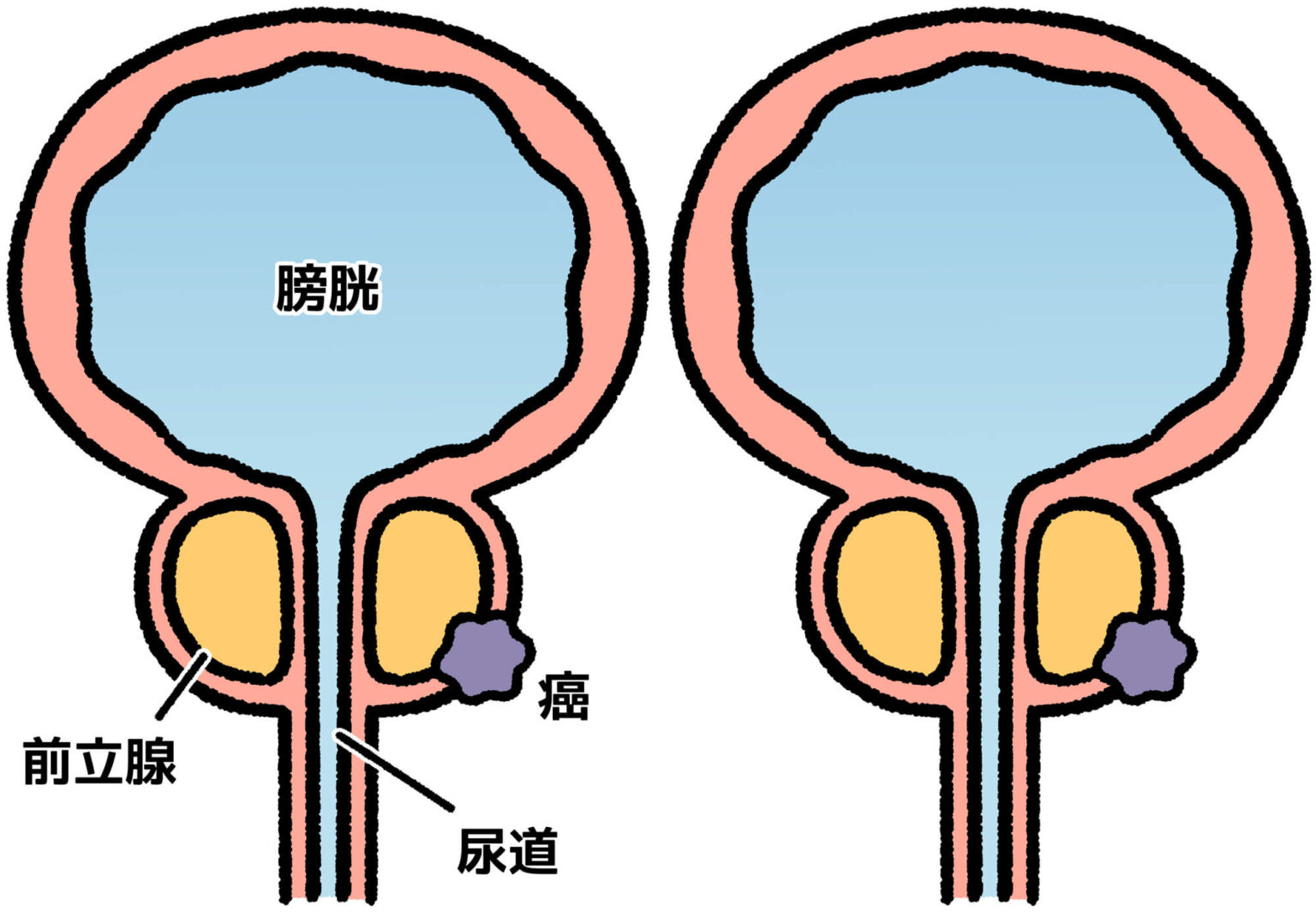 前立腺がんの早期警告兆候は何ですか?