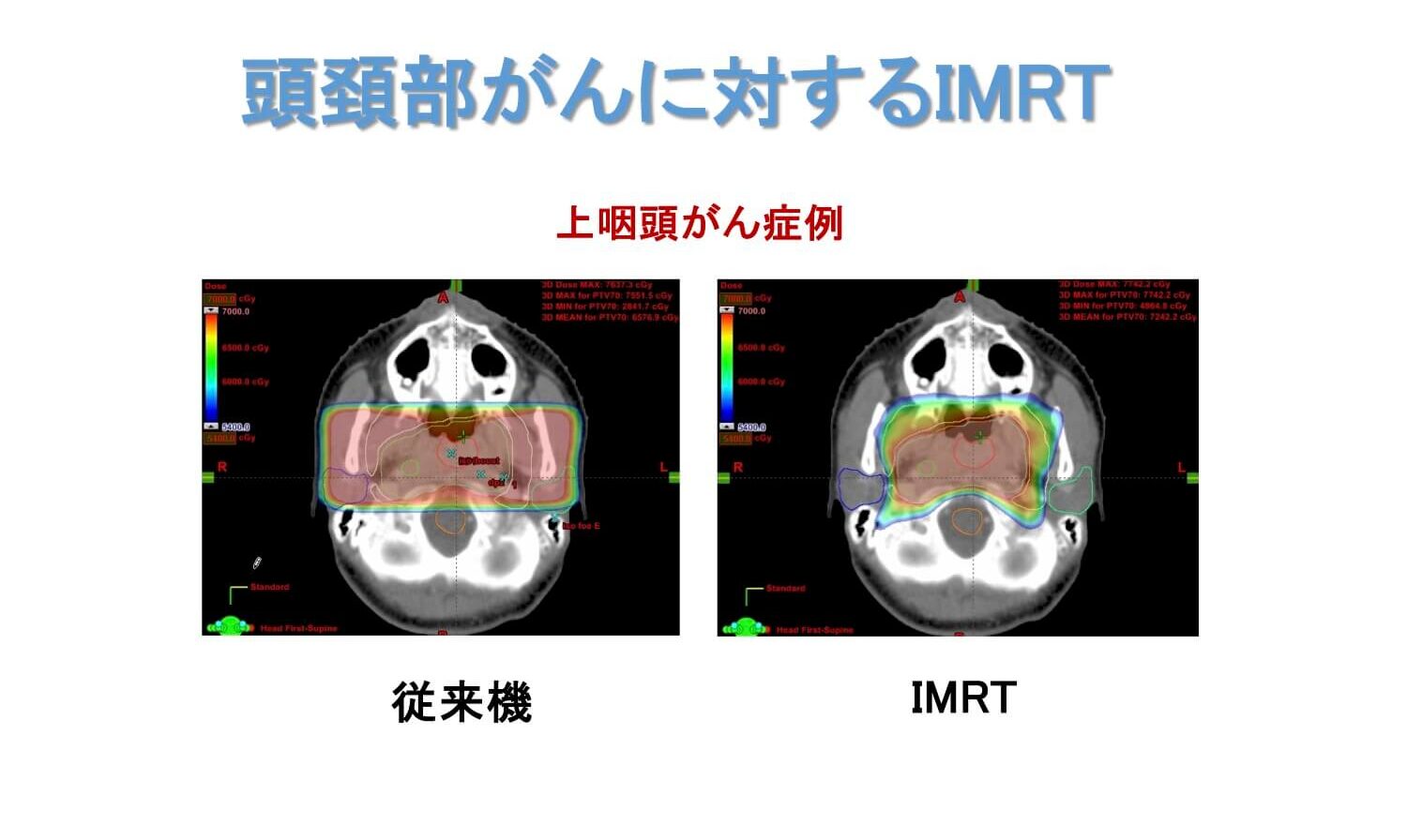 頭頸部癌に対するIMRT