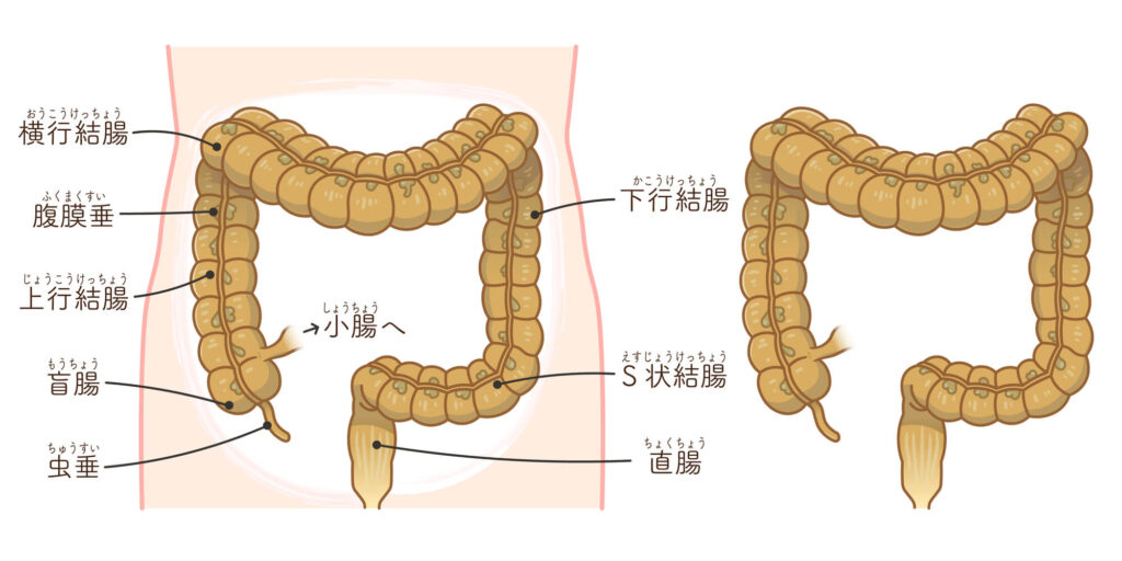 大腸がんとはどのような病気？
