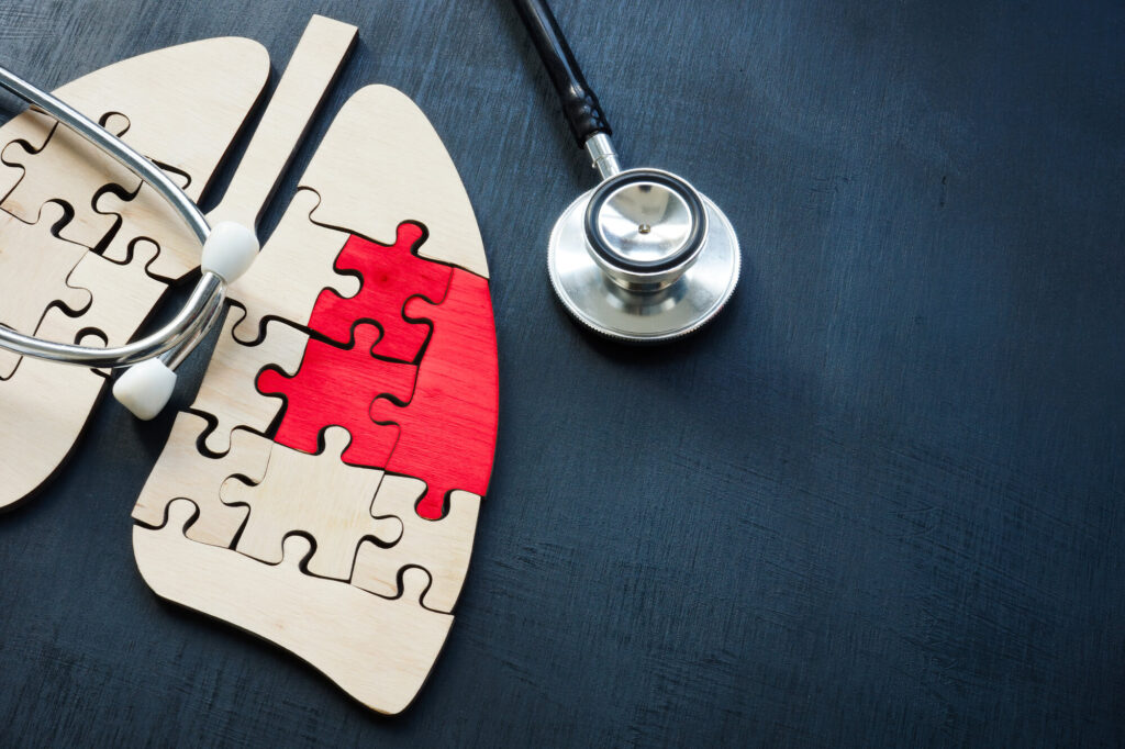 肺がんの末期・ステージ4における治療の選択肢について